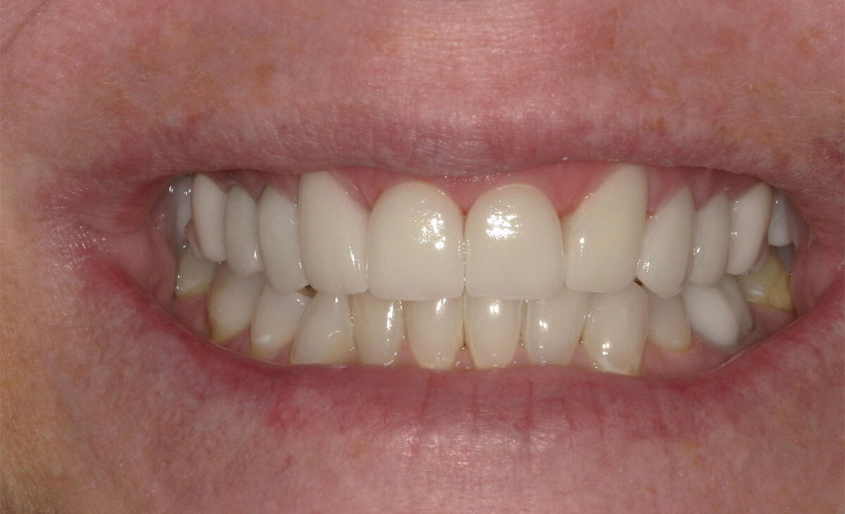 After (2)