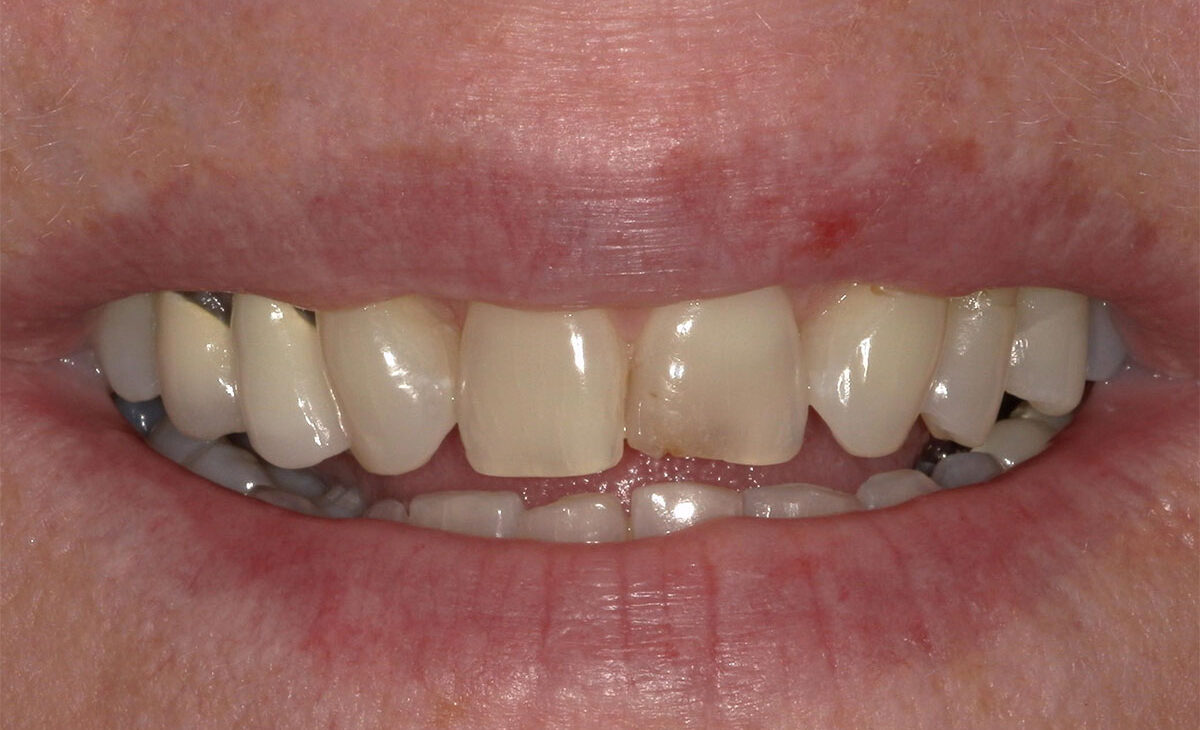 Before (2)